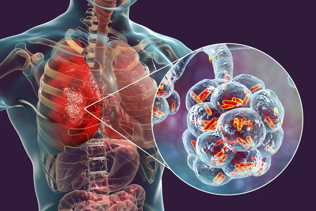 Lung Disease from Legionella infection, Legionella sampling in Ontario